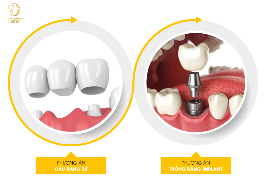 phương án trồng răng Implant và bắc cầu sứ. phương án trồng răng Implant và bắc cầu sứ.
