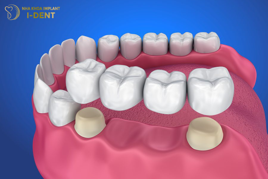 Cầu răng sứ được chỉ định khi không đủ điều kiện sức khỏe để trồng răng Implant Cầu răng sứ được chỉ định khi không đủ điều kiện sức khỏe để trồng răng Implant