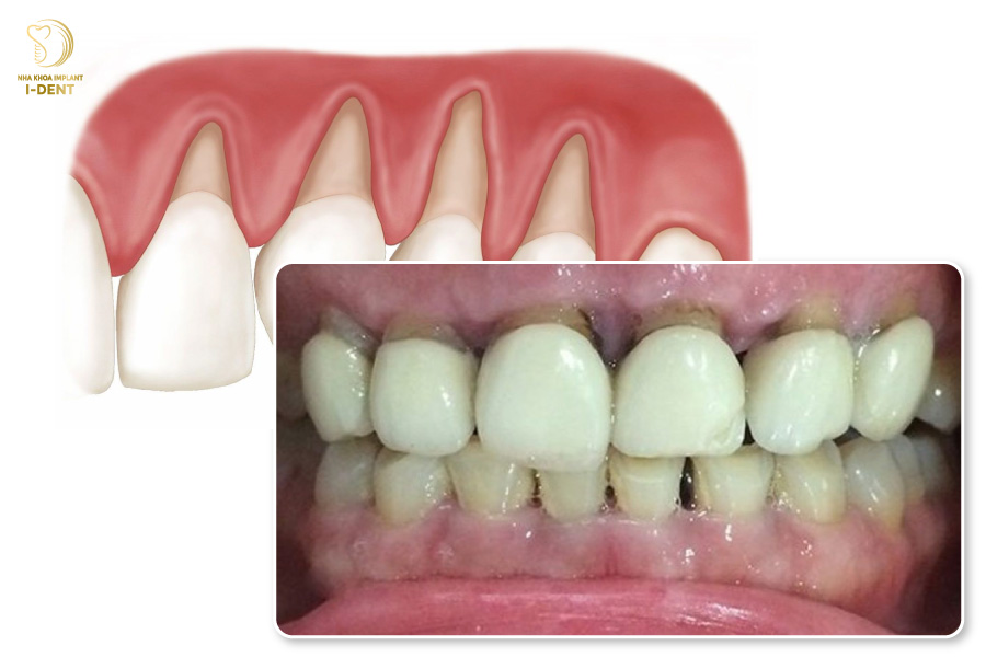 Cầu răng sứ gây tụt nướu và dẫn đến nhiều bệnh lý răng miệng Cầu răng sứ gây tụt nướu và dẫn đến nhiều bệnh lý răng miệng