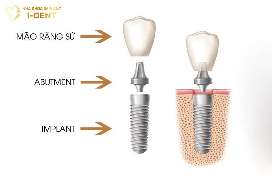 Hình ảnh cấu tạo trụ Implant Hình ảnh cấu tạo trụ Implant