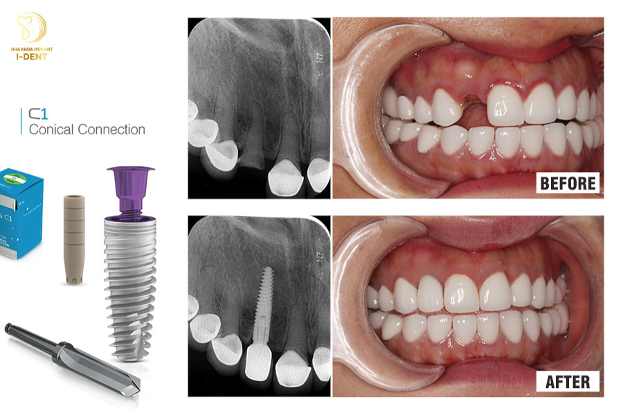 Cấy ghép Implant có thể khắc phục được tình trạng tiêu xương Cấy ghép Implant có thể khắc phục được tình trạng tiêu xương