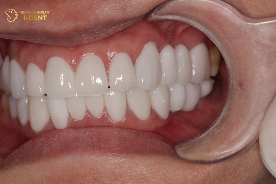 Cấy Implant cho trường hợp mất 4 răng liên tiếp Cấy Implant cho trường hợp mất 4 răng liên tiếp