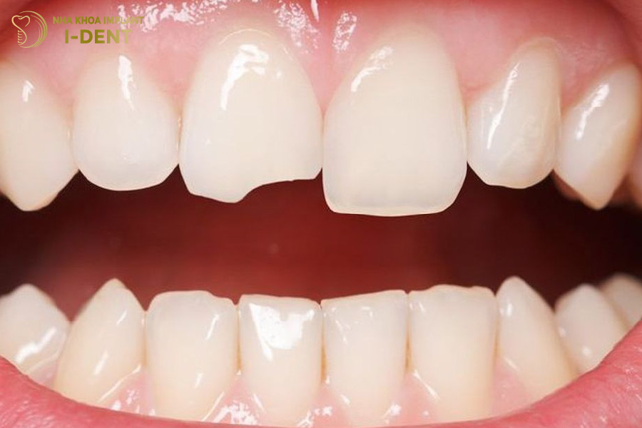 Chấn thương do tai nạn là nguyên nhân phổ biến gây mẻ răng cửa Chấn thương do tai nạn là nguyên nhân phổ biến gây mẻ răng cửa
