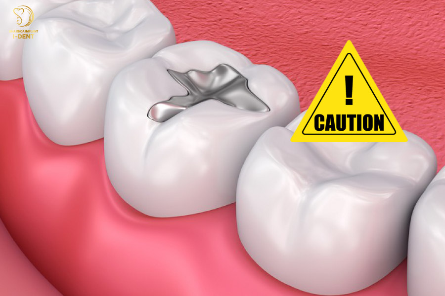 Chất liệu trám không chất lượng cũng là nguyên do làm cho bạn bị đau nhức Chất liệu trám không chất lượng cũng là nguyên do làm cho bạn bị đau nhức