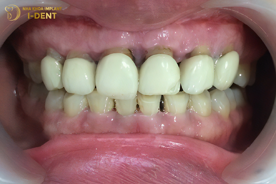 Chất lượng răng sứ kém Chất lượng răng sứ kém