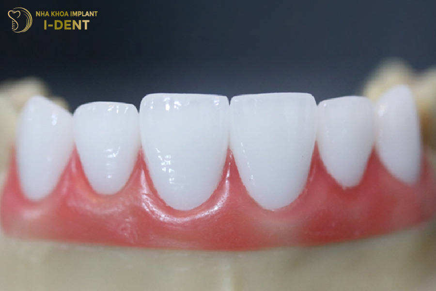 Chất sứ lành tính, an toàn với răng miệng Chất sứ lành tính, an toàn với răng miệng