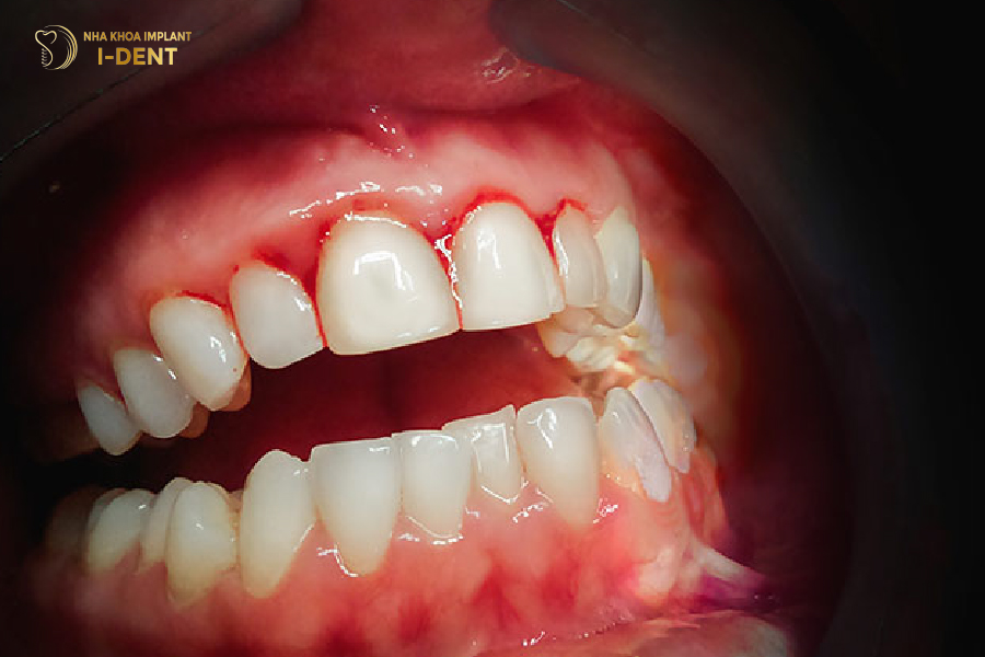 Chảy máu chân răng do không điều trị bệnh lý răng miệng triệt để Chảy máu chân răng do không điều trị bệnh lý răng miệng triệt để