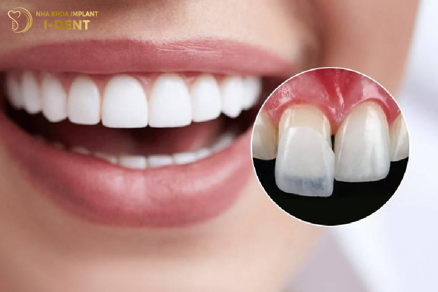 Dán sứ Veneer giúp khắc phục răng cửa thưa Dán sứ Veneer giúp khắc phục răng cửa thưa