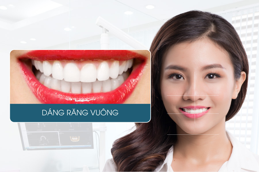 Dáng răng cửa vuông vặn răng sứ đẹp nhất