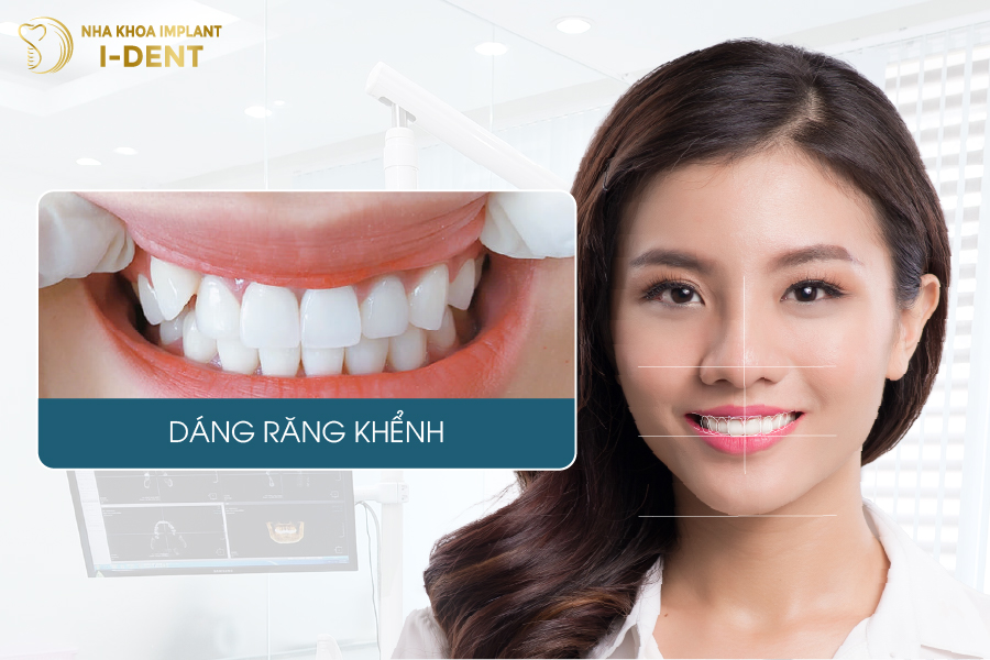 Dáng răng khểnh mang lại nụ cười duyên dáng Dáng sứ răng khểnh