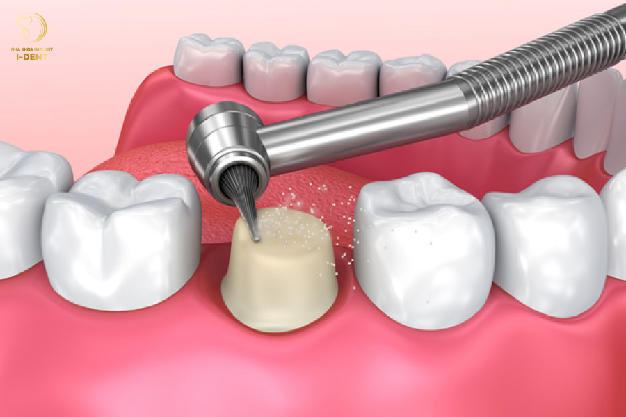 Mài răng quá nhiều làm xâm hại đến răng thật hậu quả bọc răng sứ