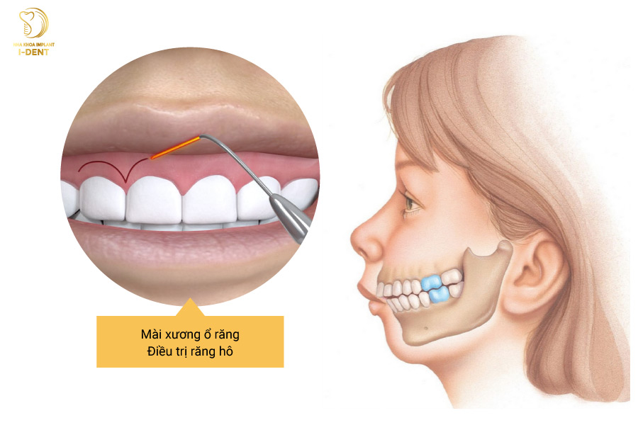 Mài xương ổ răng điều trị răng hô Mài xương ổ răng điều trị răng hô