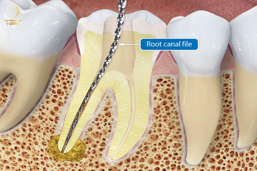 triệt tủy răng giá bao nhiêu - Răng cần được lấy tủy trước khi điều trị viêm nhiễm triệt tủy răng giá bao nhiêu - Răng cần được lấy tủy trước khi điều trị viêm nhiễm