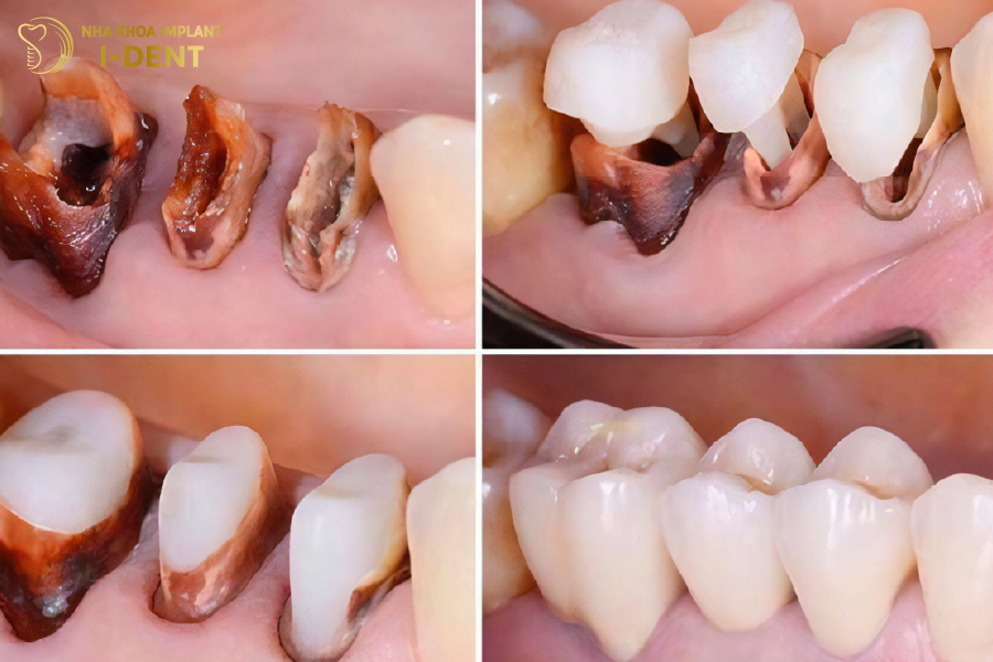 Gắn cùi răng giả có đau không? Gắn cùi răng giả có đau không?