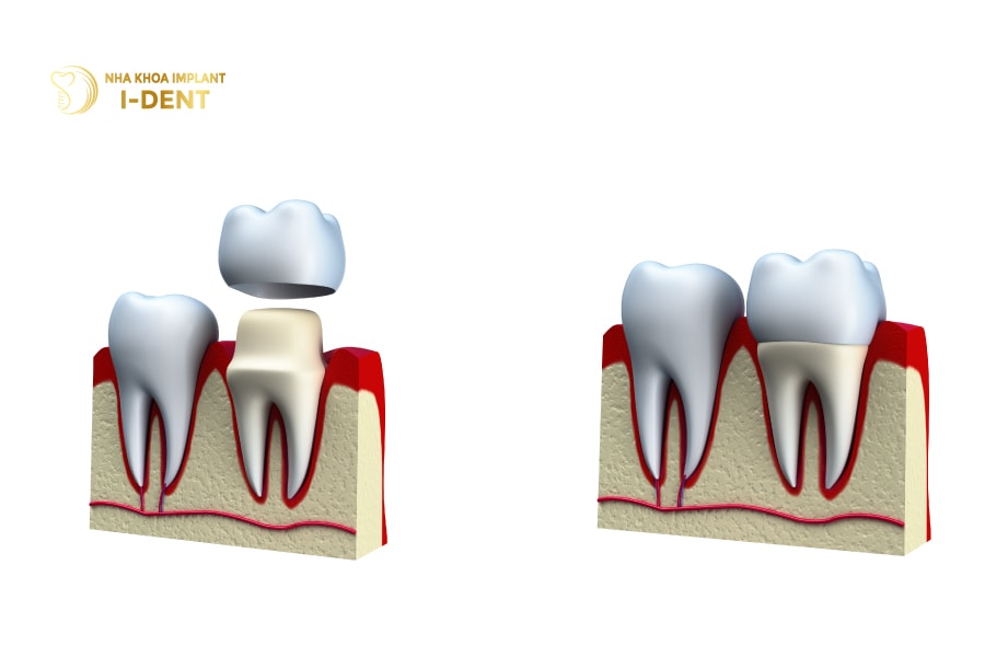 Gắn răng sứ Zirconia Ceramill Zolid Gắn răng sứ Zirconia Ceramill Zolid