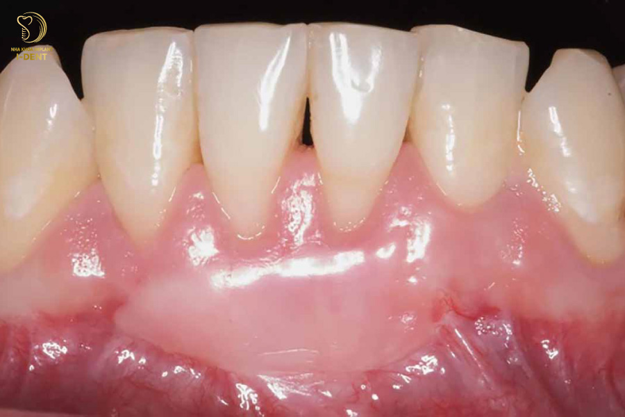 Ghép vạt nướu sẽ giúp răng cố định chắc chắn hơn Ghép vạt nướu sẽ giúp răng cố định chắc chắn hơn