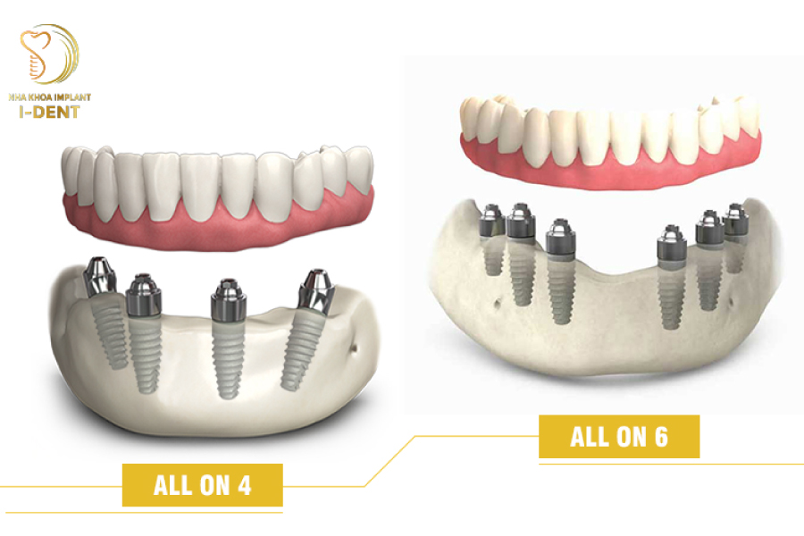 Phương pháp cấy ghép implant toàn hàm All on 4/All on 6 mất răng toàn hàm
