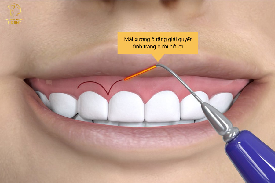 Mài xương ổ răng giải quyết tình trạng cười hở lợi Mài xương ổ răng giải quyết tình trạng cười hở lợi