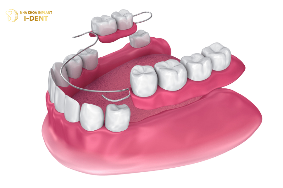 Hàm giả tháo lắp cho 4 răng liên tiếp Hàm giả tháo lắp cho 4 răng liên tiếp