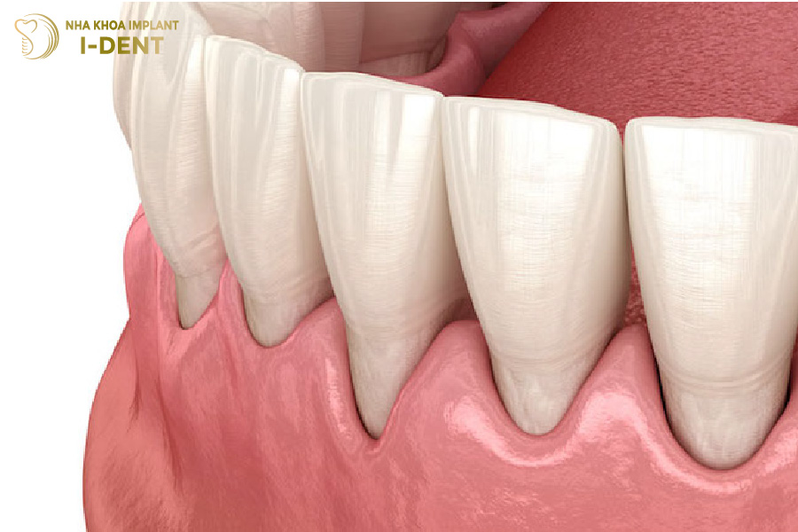 Hiện tượng bọc sứ bị tụt lợi Làm răng sứ bị tụt lợi