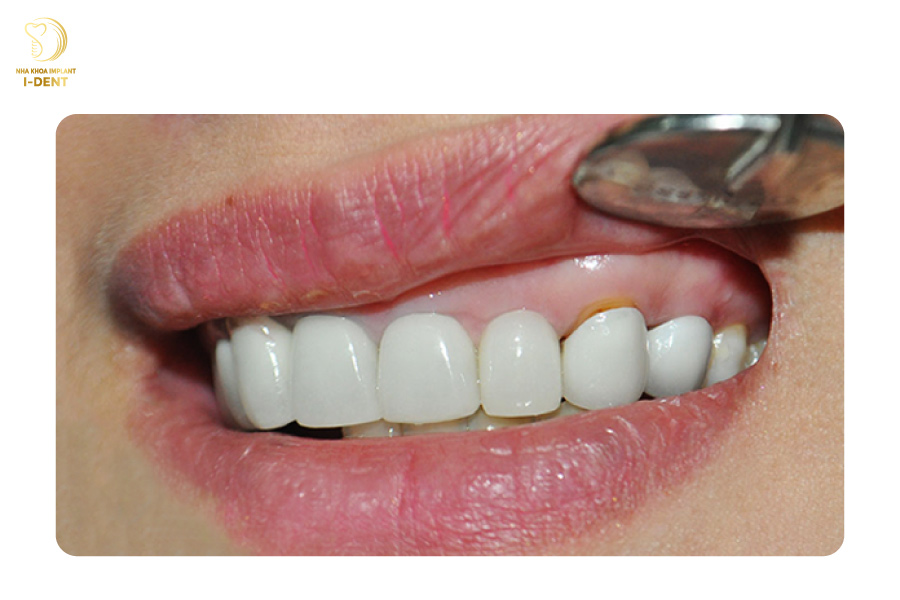 Bị hở cổ chân răng bọc răng sứ có ảnh hưởng gì không