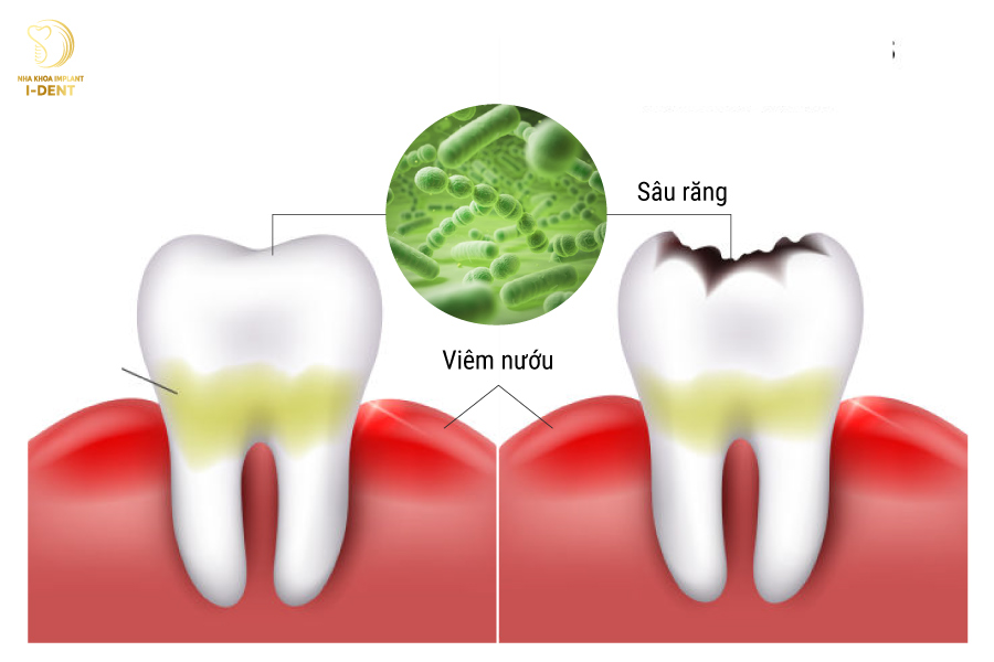 Răng bị viêm tủy do vi khuẩn gây hại tấn công hoặc bị nhiễm độc Răng bị viêm tủy do vi khuẩn gây hại tấn công hoặc bị nhiễm độc