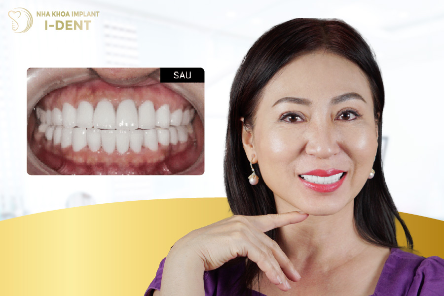 Hình ảnh chị Nhung sau khi hoàn toàn quá trình bọc sứ Hình ảnh chị Nhung sau khi hoàn toàn quá trình bọc sứ