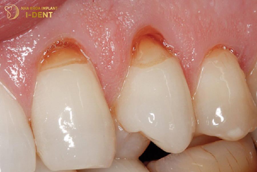 Hình ảnh răng bị mòn cổ chân răng Hình ảnh răng bị mòn cổ chân răng