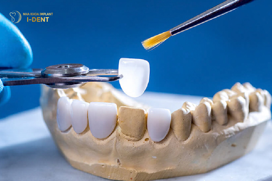 Hình ảnh răng sứ Veneer Hình ảnh răng sứ Veneer