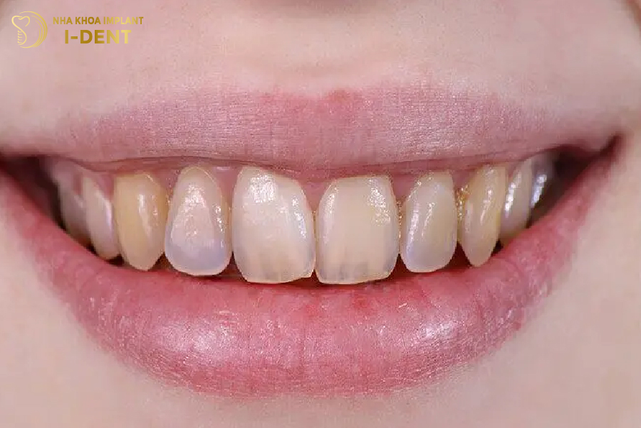 Răng thật bị tổn thương men răng Răng thật bị tổn thương men răng