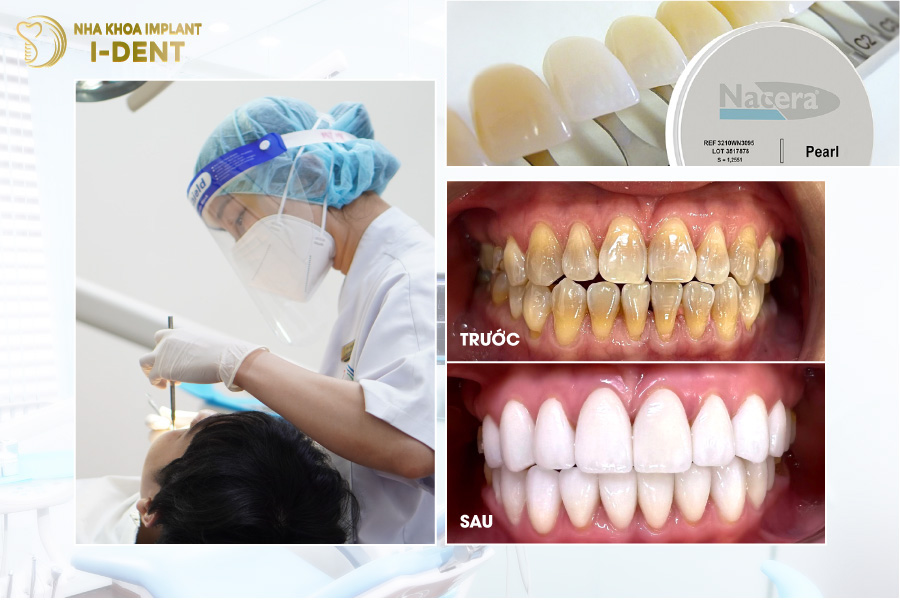 Hình ảnh răng toàn sứ Nacera 9 Max độc quyền tại nha khoa I-DENT Hình ảnh răng toàn sứ Nacera 9 Max độc quyền tại nha khoa I-DENT