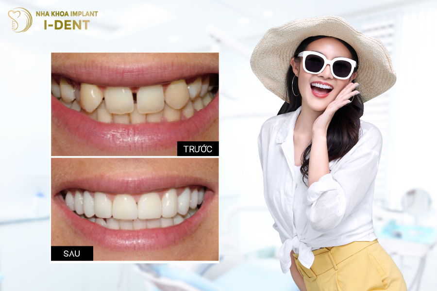 Hình ảnh trước - sau của khách hàng dán sứ tại I-DENT Hình ảnh trước - sau của khách hàng dán sứ tại I-DENT