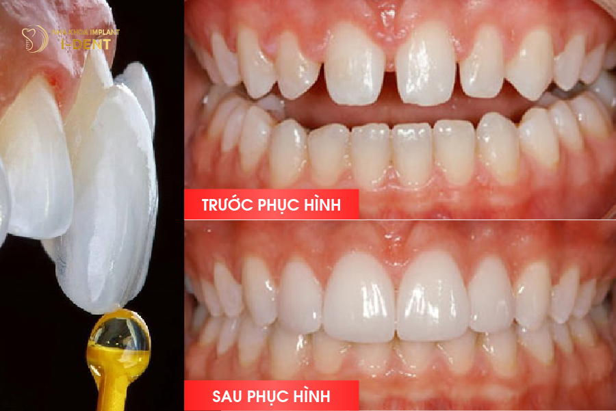Hình ảnh trước và sau khi dán sứ Veneer ( trường hợp răng thưa ở mức độ nhẹ ) Hình ảnh trước và sau khi dán sứ Veneer ( trường hợp răng thưa ở mức độ nhẹ )