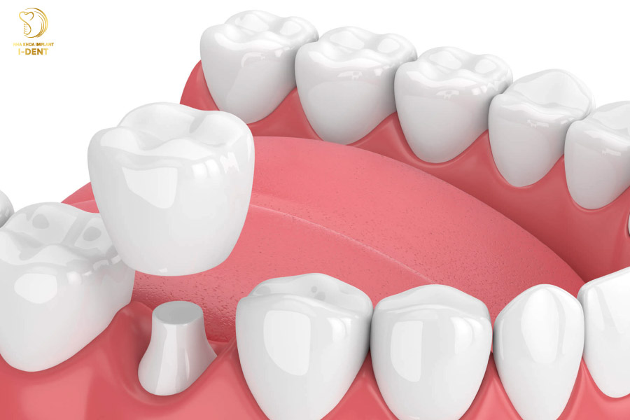Bọc răng sứ có thể khắc phục được nhiều khuyết điểm răng miệng Bọc răng sứ có thể khắc phục được nhiều khuyết điểm răng miệng