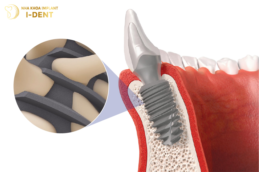 Implant Tekka có khả năng tích hợp tốt với mọi tình trạng xương hàm Tekka Implant