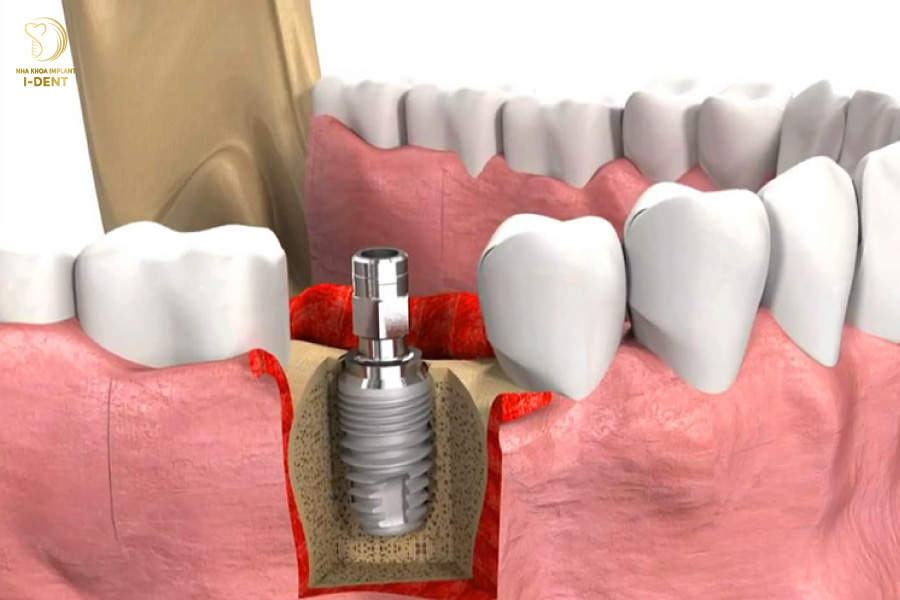 Implant Tekka được sản xuất bởi tập đoàn Global D Implant Tekka