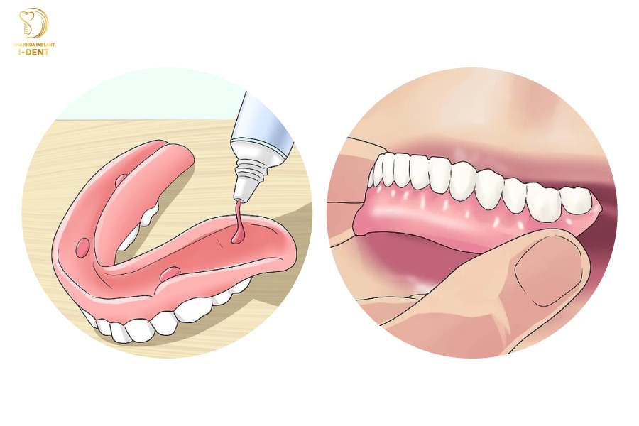 Người sử dụng hàm giả tháo lắp thường xuyên phải sử dụng keo dán hàm giả để cố định hàm