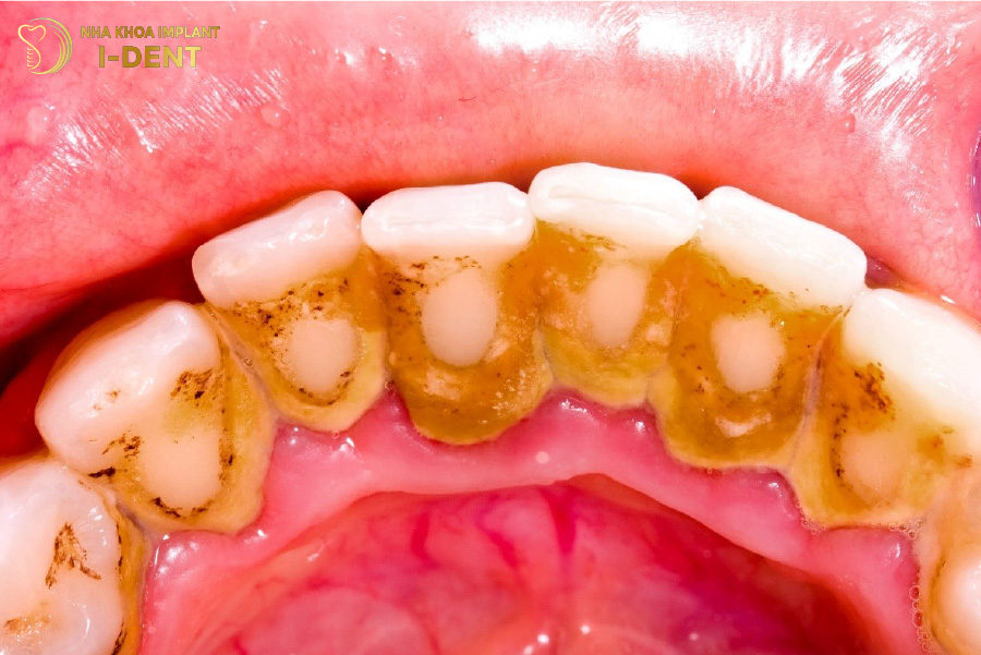Vệ sinh răng miệng kém là nguyên nhân hàng đầu gây mùi hôi miệng cách trị hôi miệng khi bọc răng sứ