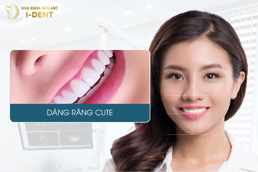 Kiểu răng cute dáng răng