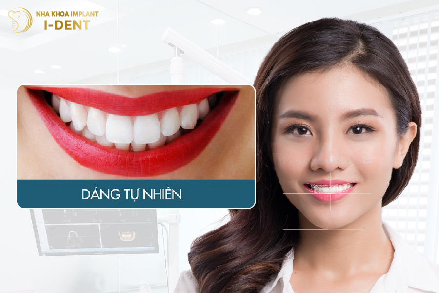 Kiểu răng dáng tự nhiên răng sứ tự nhiên