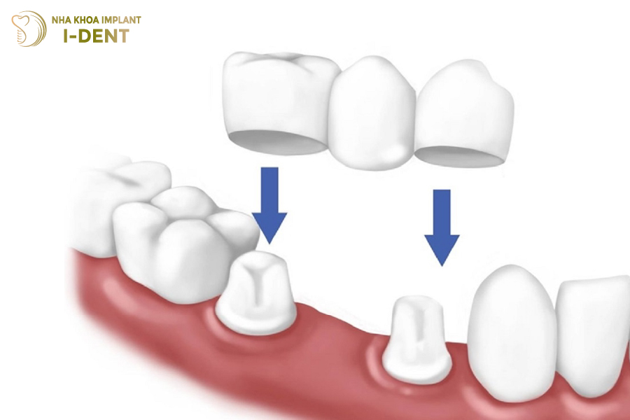 Kỹ thuật cầu răng sứ giúp khôi phục răng mất Kỹ thuật cầu răng sứ giúp khôi phục răng mất