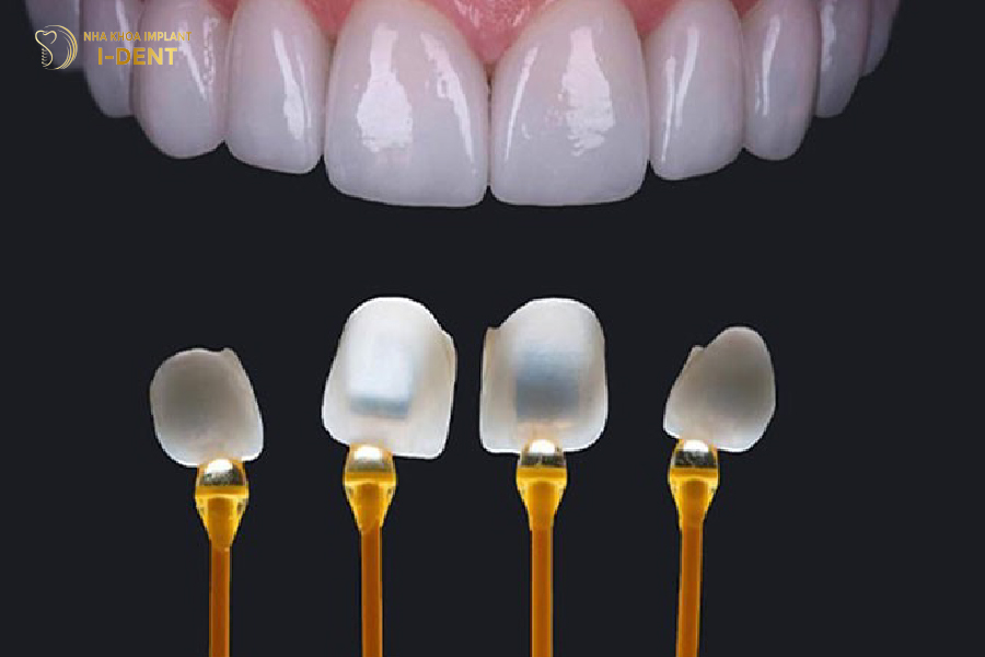 Kỹ thuật dán sứ không mài răng Kỹ thuật dán sứ không mài răng