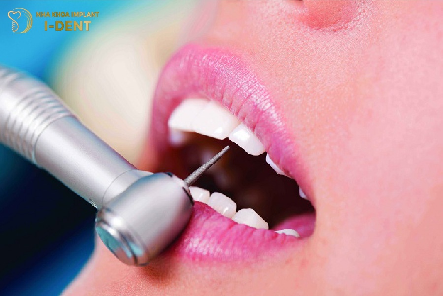 Kỹ thuật mài cùi răng cần được thực hiện bởi bác sĩ có chuyên môn Kỹ thuật mài cùi răng cần được thực hiện bởi bác sĩ có chuyên môn