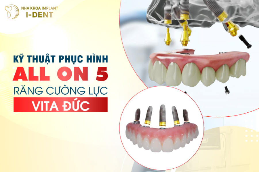 Sử dụng răng cường lực Vita Đức trong kỹ thuật phục hình All on 5 Sử dụng răng cường lực Vita Đức trong kỹ thuật phục hình All on 5