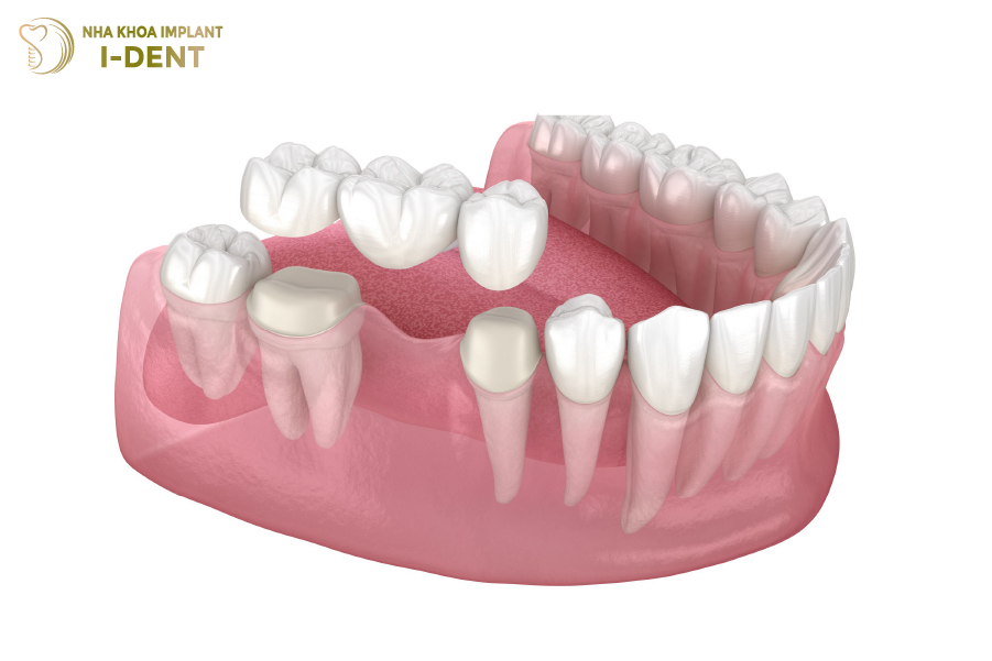 Làm cầu răng cửa có khá nhiều ưu điểm Làm cầu răng cửa có khá nhiều ưu điểm