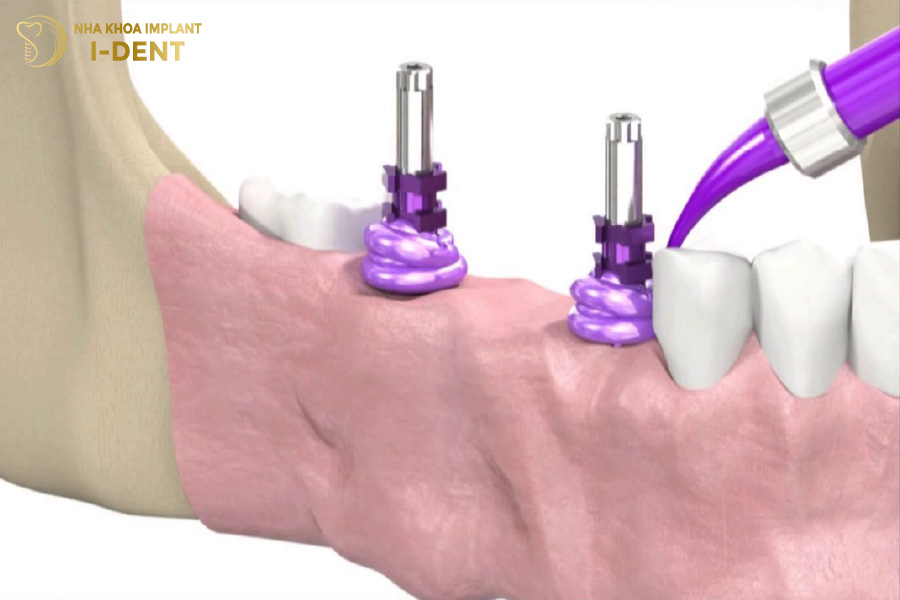 Lấy dấu Implant giúp chế tác mão sứ phù hợp với trụ răng lấy dấu implant