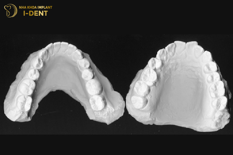 Lấy dấu răng bằng thạch cao lấy dấu implant