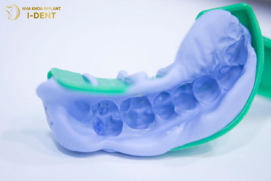Lấy dấu sai sót sẽ dẫn tới chế tác ra răng sứ sai lệch về hình dáng, kích thước lấy implant