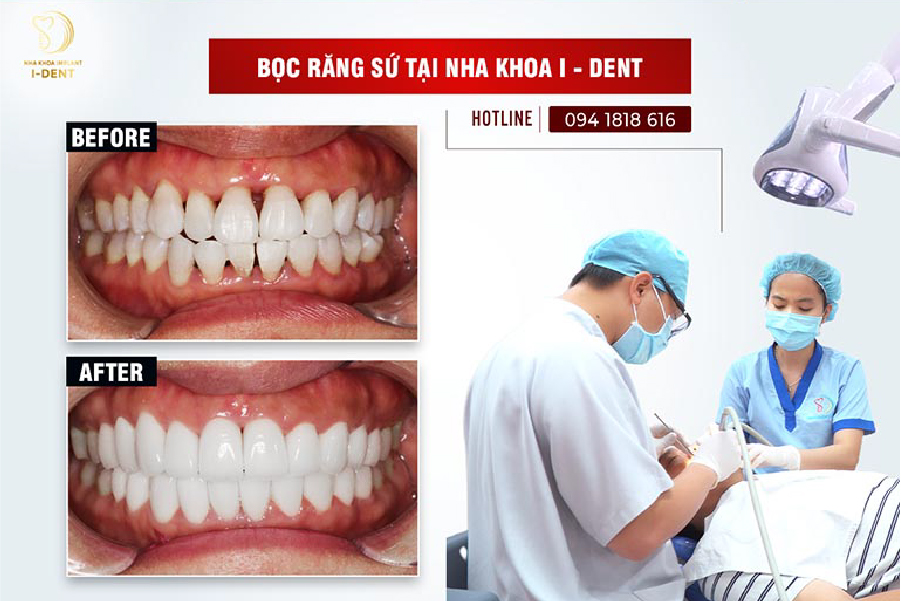 Để tăng tính thẩm mỹ cho cả hàm răng, nhiều khách hàng chọn bọc 16 răng sứ Để tăng tính thẩm mỹ cho cả hàm răng, nhiều khách hàng chọn bọc 16 răng sứ