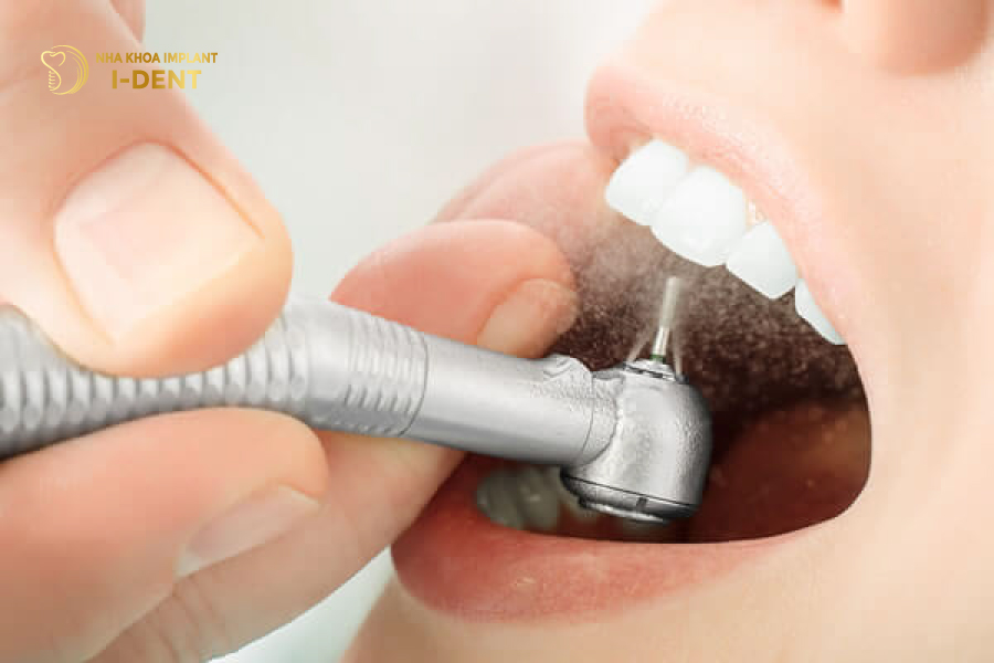 Nên thực hiện mài răng bọc sứ ở địa chỉ nha khoa uy tín mài răng sứ